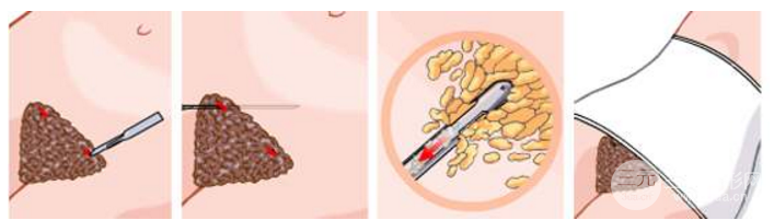 2019年腰部吸脂減肥價格一覽表 附抽脂圖