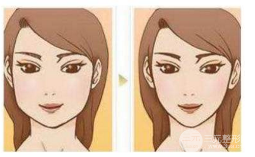 改臉型手術(shù)多少錢