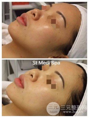光子嫩膚面部皺紋成好嗎