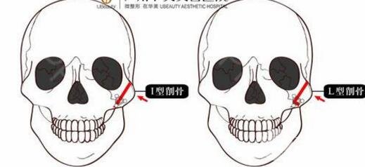 磨骨瘦臉十年后圖片