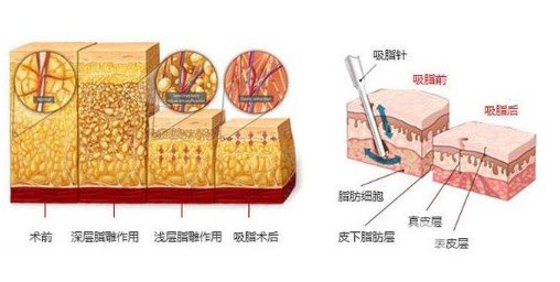 臀部吸脂塑形有果嗎