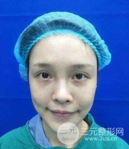 酒窩手術(shù)失敗圖片