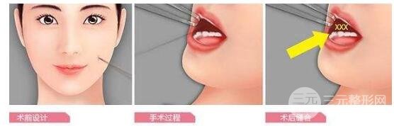 酒窩手術(shù)的注意事項(xiàng)