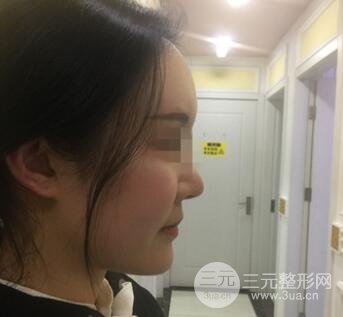 　酒窩手術(shù)案例