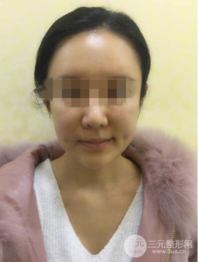 　酒窩手術(shù)案例