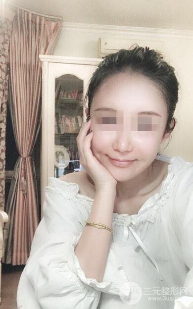 　酒窩手術(shù)案例