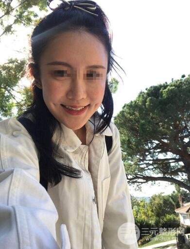 　酒窩手術(shù)案例