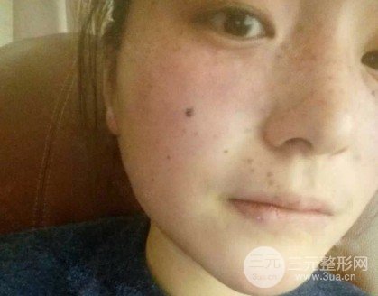 去痣多少錢一顆