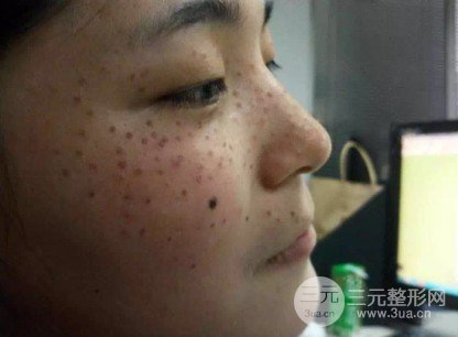 去痣多少錢一顆