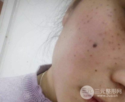 去痣多少錢一顆