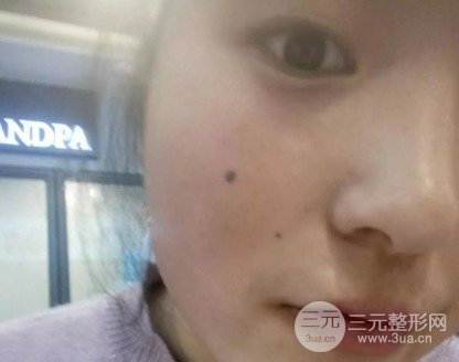 去痣多少錢一顆