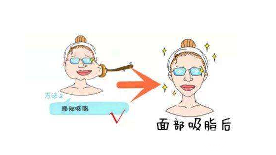 吸脂瘦臉手術(shù)術(shù)后一定要注意這些，別說我沒告訴你！