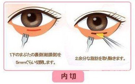 內切去眼袋幾天恢復