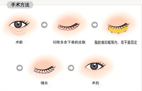 內切去眼袋幾天恢復