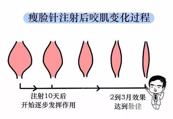 注射瘦臉瘦臉