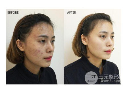 復合彩光嫩膚的作用