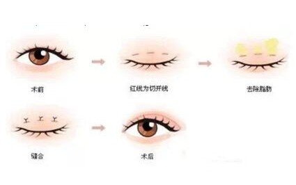 微創(chuàng)雙眼皮手術(shù)多久恢復(fù)