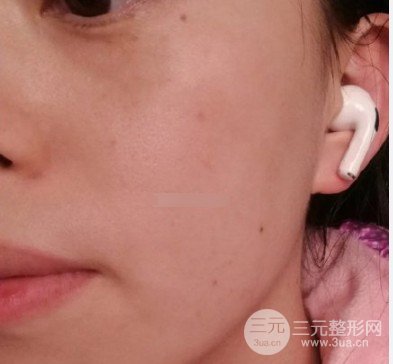 c8激光祛斑案例