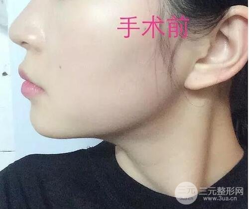 墊下巴前后對比果圖發(fā)布，小V臉的精髓就在這里啦！