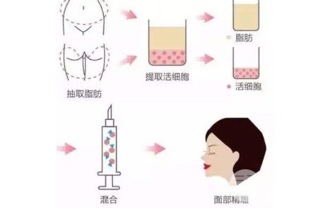 脂肪填充蘋果肌兩天后腫了