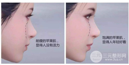 脂肪填充蘋果肌兩天后腫了