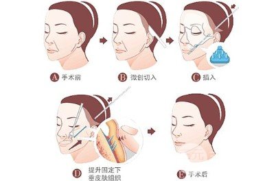 脂肪填充額頭對比圖