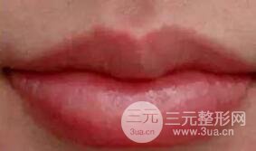 M唇手術(shù)的果怎么樣?