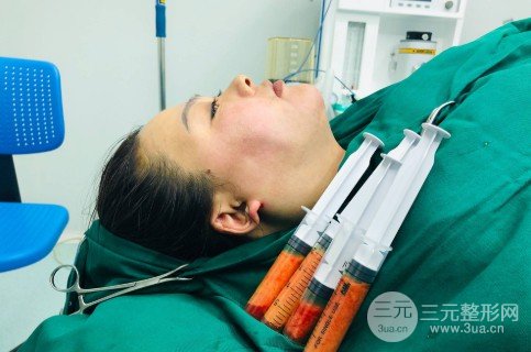 面部吸脂會(huì)反彈嗎