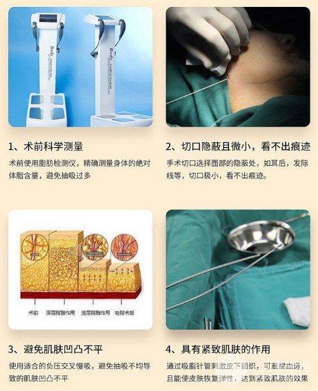 面部吸脂會(huì)反彈嗎