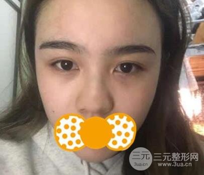 鼻頭縮小術(shù)后對(duì)比照，手術(shù)原理解析+注意事項(xiàng)羅列