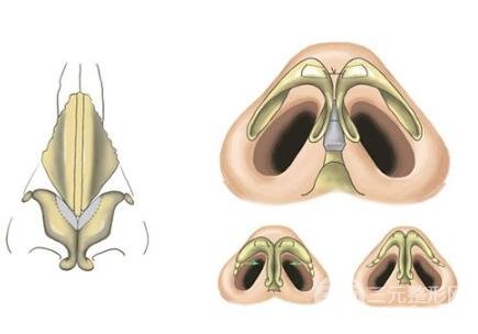什么是鼻頭縮小術(shù)?