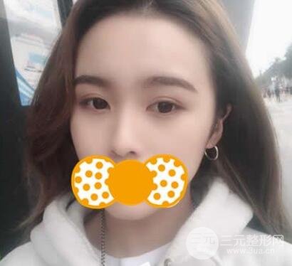 鼻頭縮小術(shù)后對(duì)比照，手術(shù)原理解析+注意事項(xiàng)羅列