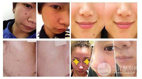 點(diǎn)痦子疼嗎