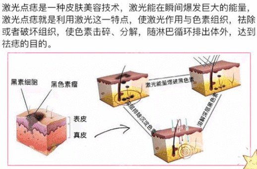 點(diǎn)痦子疼嗎