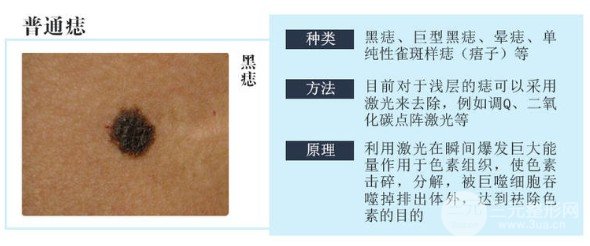 點(diǎn)痦子疼嗎