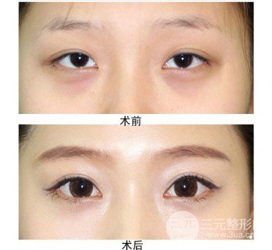 開眼角手術(shù)風(fēng)險大嗎