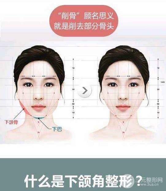 國字臉削骨價格一般多少錢？手術(shù)注意事項以及案例圖分享~