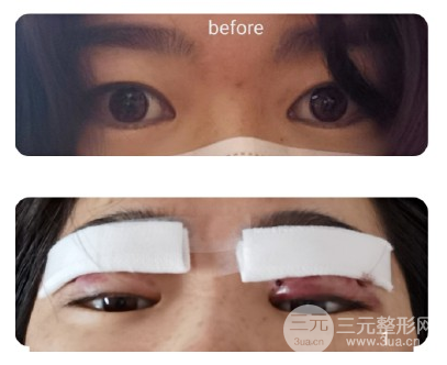 雙眼皮手術(shù)疼嗎