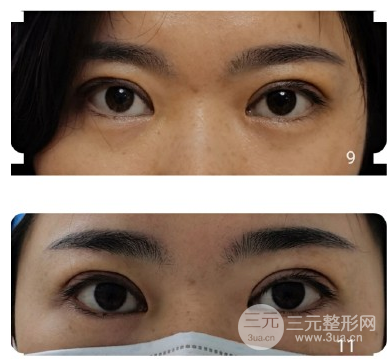 雙眼皮手術(shù)疼嗎