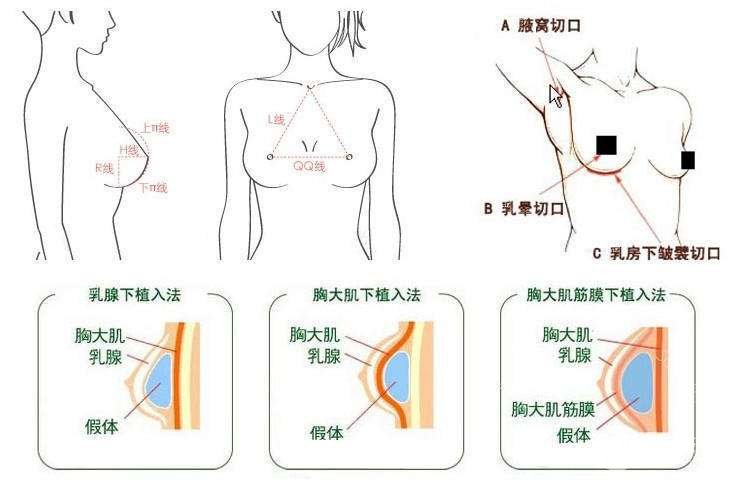 c罩杯多大胸圖片欣賞丨胸部整形手術(shù)之后需要注意什么？
