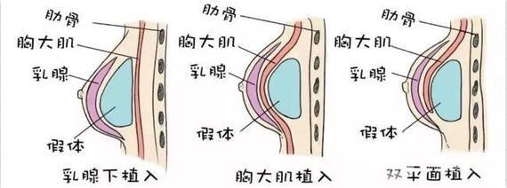 做完隆胸手術(shù)后多久可以側(cè)著睡?