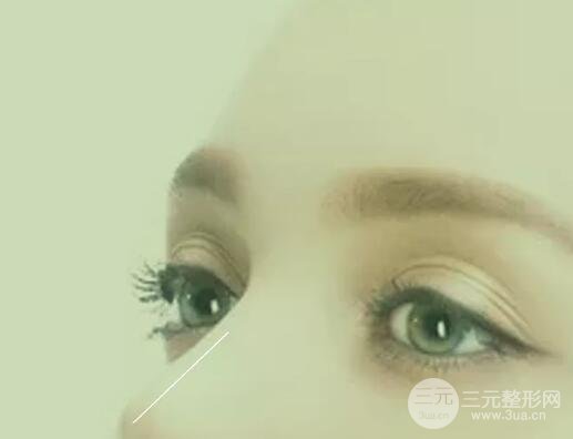 割完雙眼皮一到7天圖片真人術(shù)后參考，一起見(jiàn)證雙眼皮的誕生！