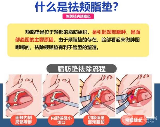 取頰脂墊合適群體