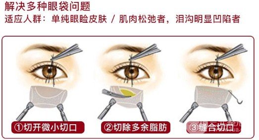 眼袋切除手術(shù)能保幾年