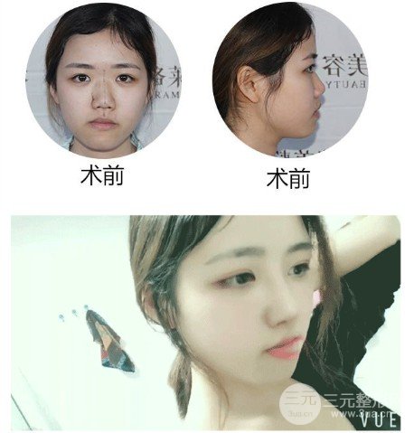 耳軟骨墊鼻尖吸收率很高嗎