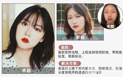 雙眼皮手術后恢復期