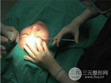 雙眼皮手術后恢復期