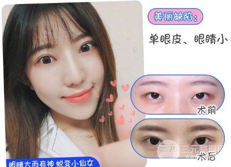 雙眼皮手術后恢復期