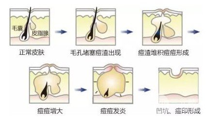激光緩解痤瘡會(huì)復(fù)發(fā)嗎
