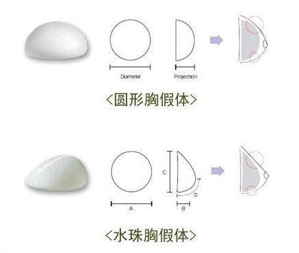 假體隆胸前應了解哪些事?